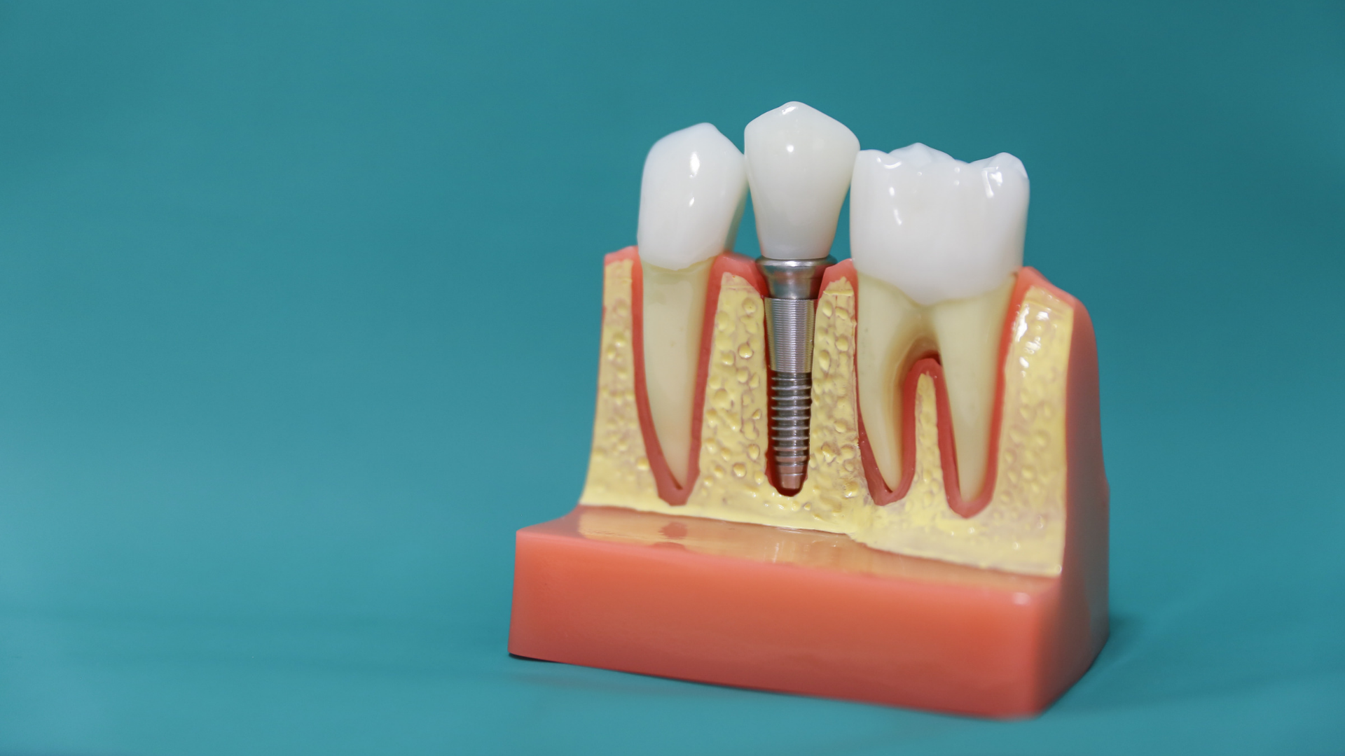 Mini Dental Implants-In which cases are they used and what are their advantages & disadvantages