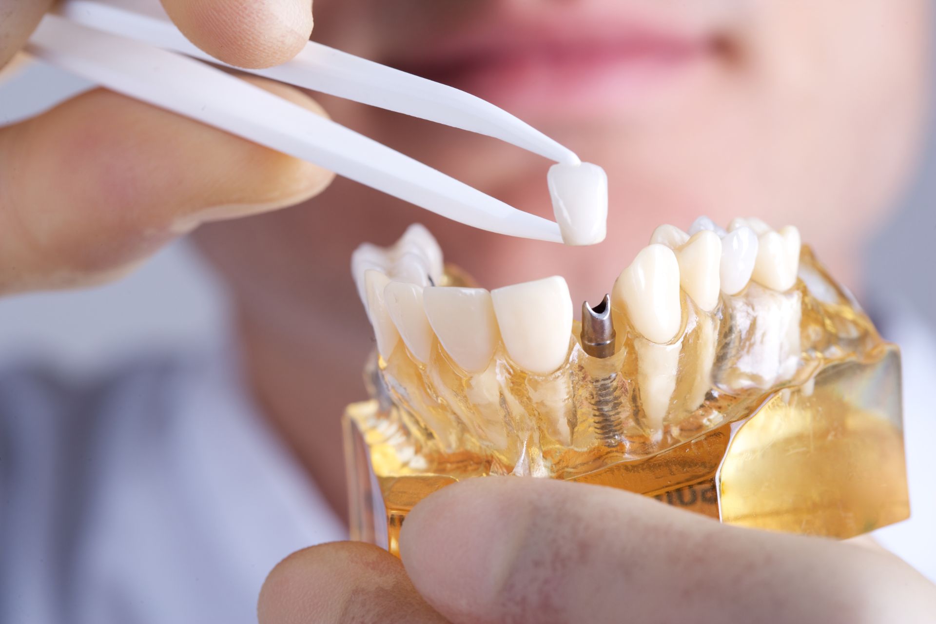 Αλήθειες Και Μύθοι για τα Εμφυτεύματα Δοντιών