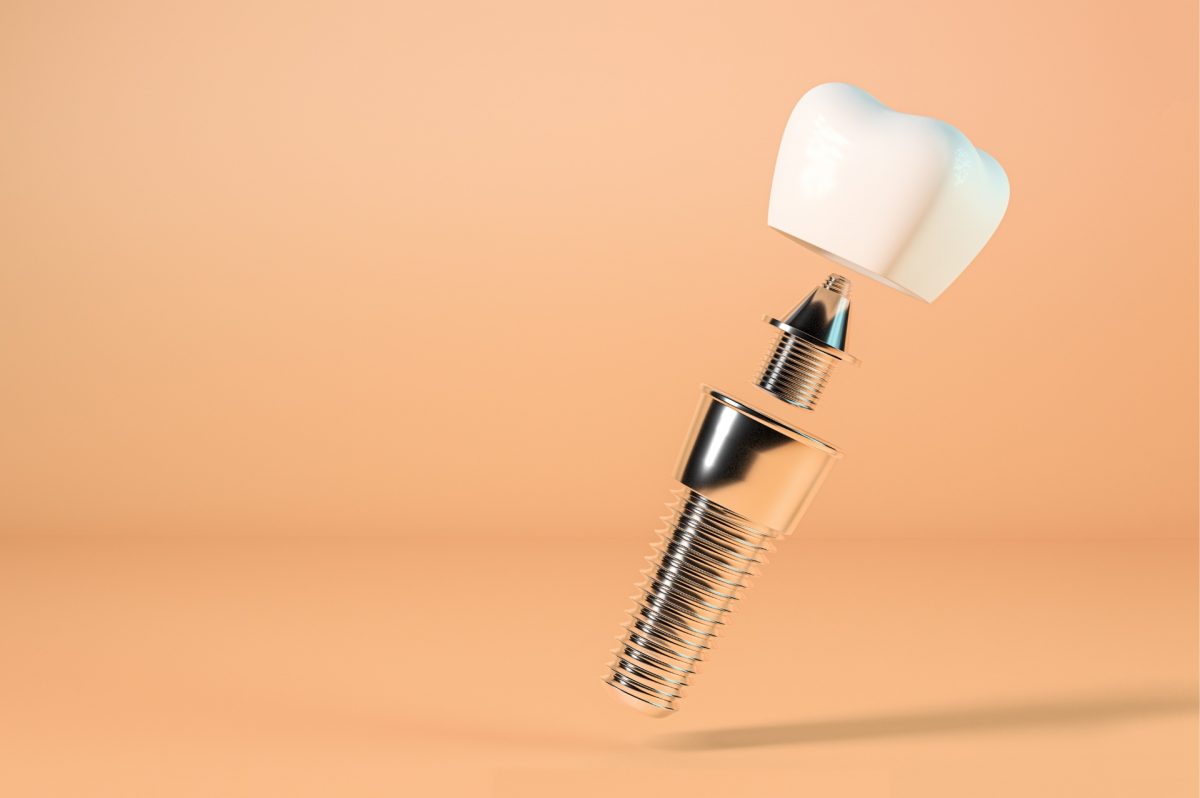 Εμφυτεύματα Δοντιών & Laser: Μία Υπερσύγχρονη Μέθοδος