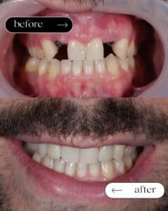 εμφυτεύματα πριν και μετά