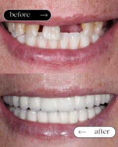 εμφυτεύματα πριν και μετά