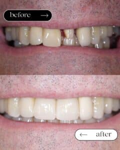 εμφυτεύματα πριν και μετά