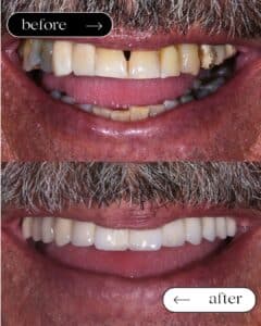 εμφυτεύματα πριν και μετά