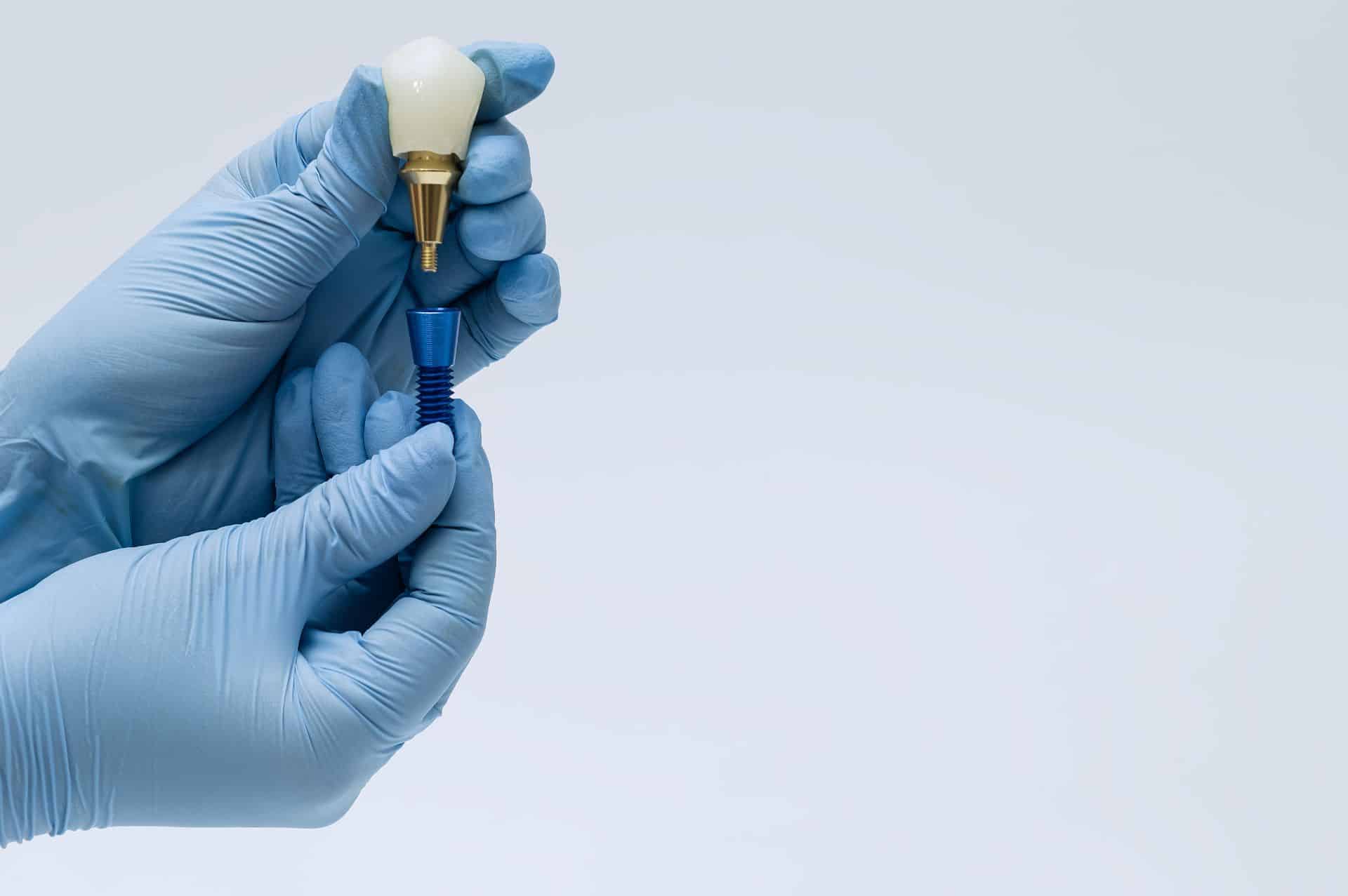 Εμφυτεύματα Πριν και Μετά: Σημαντικές Οδηγίες για Κάθε Στάδιο της Θεραπείας